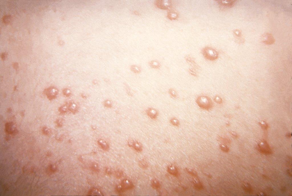 Image of chicken pox blisters