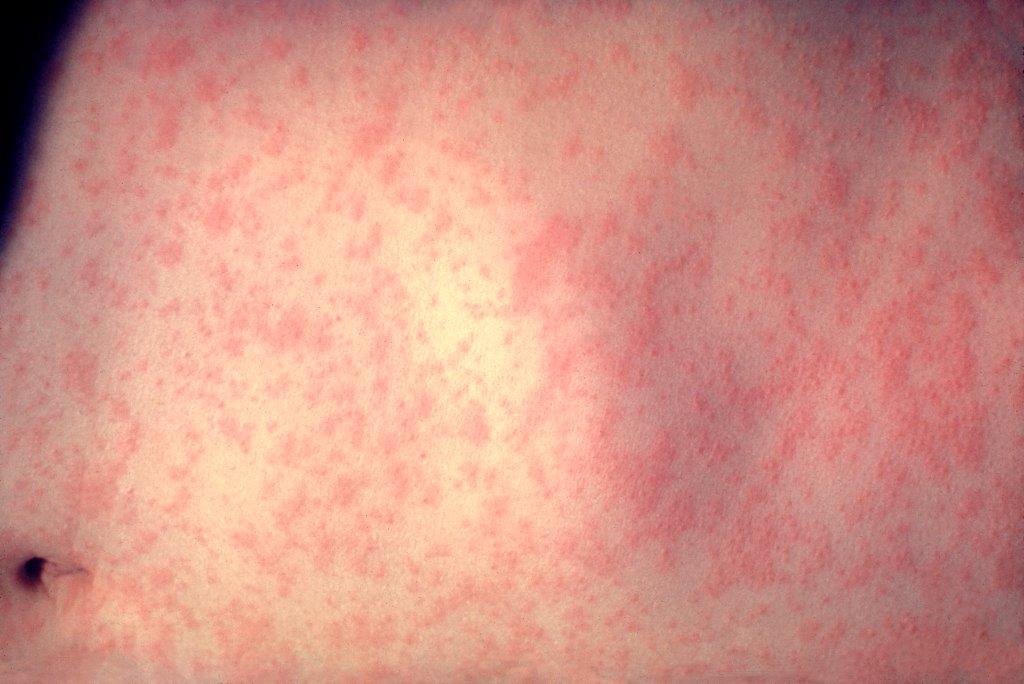 Photo of measles rash