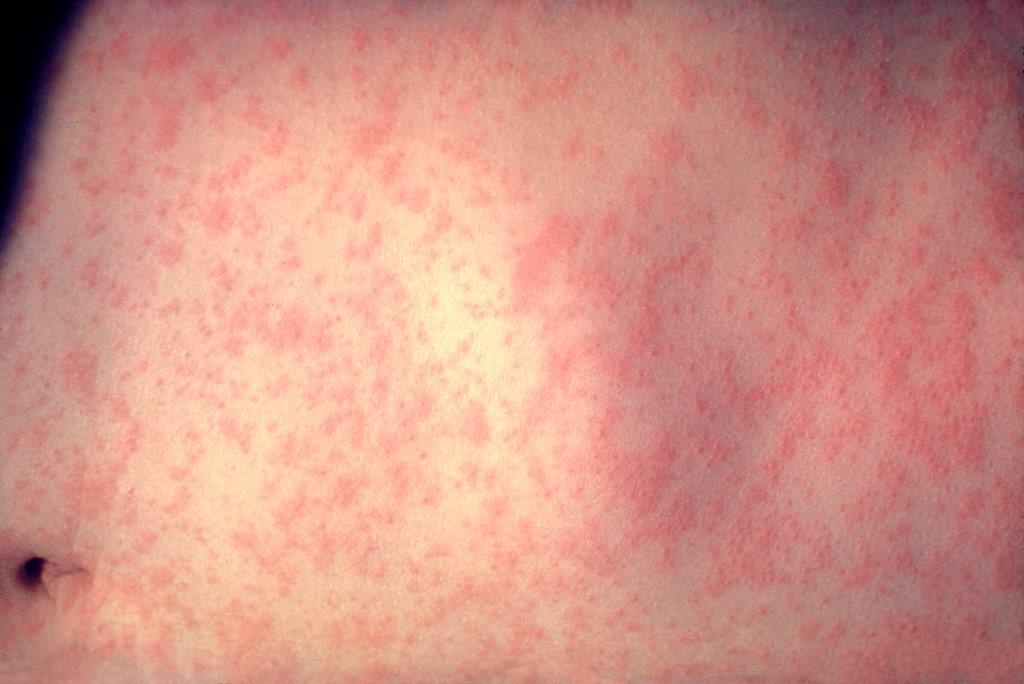 Measles rash Photo of measles rash