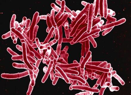 Tuberculosis Microscope image of tuberculosis