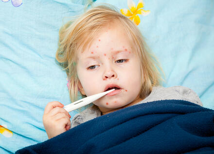 chickenpox