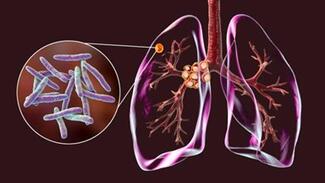 tuberculosis bacteria in the lungs